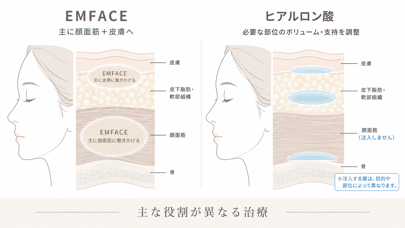 EMFACEは主に顔面筋と皮膚へアプローチし、ヒアルロン酸は必要な部位のボリュームや立体的支持を調整するという違いを示した模式図